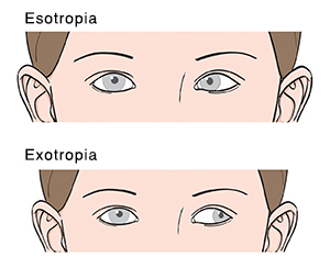 Closeup of eyes from front showing esotropia and exotropia.