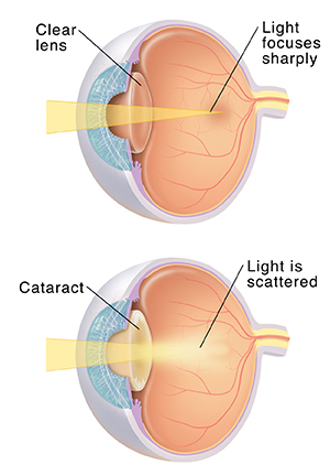 Three-quarter view of eye showing lens sharply focusing light. Three-quarter view of eye showing cataract scattering light.