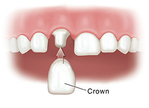 Closeup of teeth with one shaped tooth. Crown is being fitted on shaped tooth.