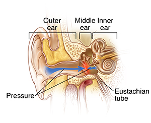 Front view cross section of outer, middle, and inner ear showing pressure on both sides of eardrum.