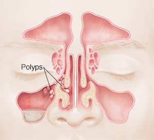 Front view of face showing sinuses with polyps.