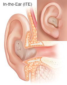 Cross section of ear showing outer, inner, and middle ear structures with in-the-ear hearing aid in place with inset of external view.