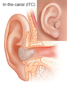 Cross section of ear showing outer, inner, and middle ear structures with in-the-canal hearing aid in place with inset of external view.