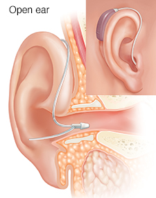 Cross section of ear showing outer, inner, and middle ear structures with receiver-in-ear hearing aid in place with inset of external view.