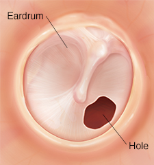 Eardrum with hole.