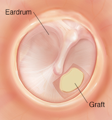 Eardrum with repaired hole.