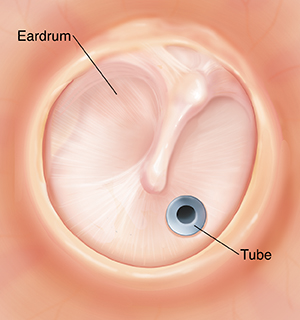 Eardrum with tube in left lower side.