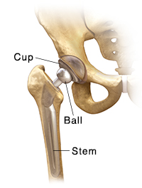 Front view of hip joint with total prosthesis in place.