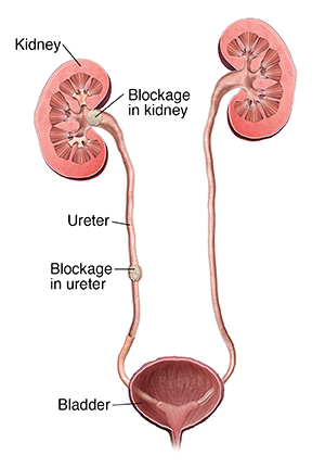 Cross section of urinary tract with stones in kidney and ureter.