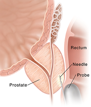 Closeup cross section of prostate and rectum. Transducer is inserted into rectum and needle is inserted into prostate.