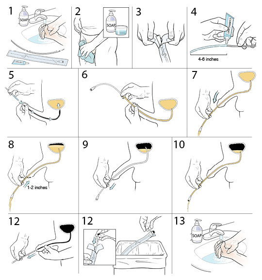 13 steps to insertig a disposable catheter