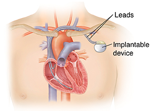 Man's chest showing pacemaker under skin with leads going into heart chambers.