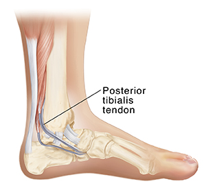 Side inside view of bones of lower leg and foot showing Achilles tendon and posterior tibialis tendon.