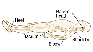 Common sites of pressure ulcers when lying on the back include the heel, sacrum, elbow, shoulder, and the back of head.