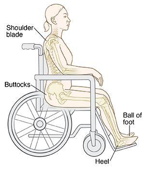 Common sites of pressure ulcers when sitting include the shoulder blade, the buttocks, the ball of the foot and the heel.