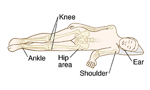 When lying on the side, pressure ulcers can occur on the ankle, knee, hip, shoulder or ear.