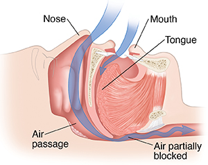 Side view cross section of head showing snoring.