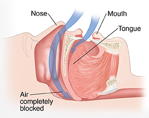 Side view cross section of head showing obstructive sleep apnea.