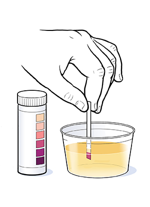 Hand inserting ketone test strip into urine in cup.