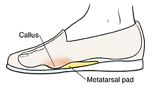 Side view of foot in shoe showing metatarsal pad and callus.