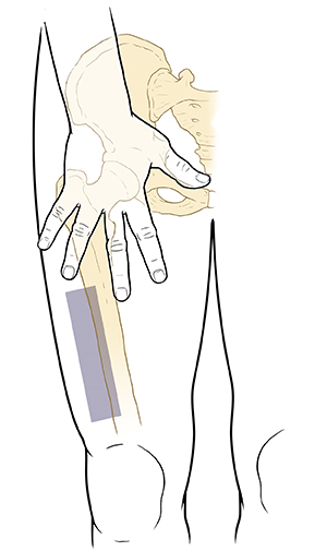 Outline front view of lower body, hip, and thigh with pelvic and leg bones showing. Hand with fingers spread is palm down on front of thigh where leg meets body. Shaded rectangle below hand and above knee, towards side of leg.