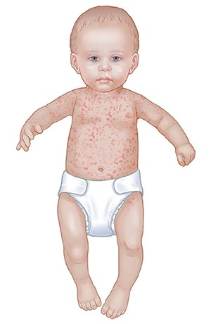 When Your Child Has Roseola When Your Child Has Roseola