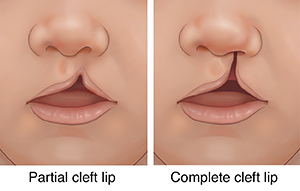 Front view of child's nose and mouth showing partial cleft lip. Front view of child's nose and mouth showing complete cleft lip.