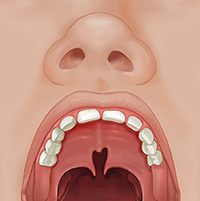 Front view of child's open mouth showing partial cleft palate.