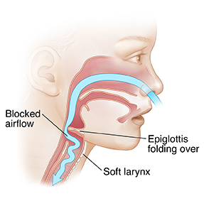 Side view of child's face showing blocked air flow caused by laryngomalacia.