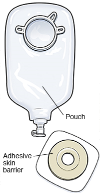 Urostomy: Selecting Your Pouch