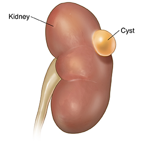 Front view of kidney with simple cyst.