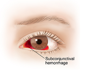 Front view of eye with subconjunctival hemorrhage.