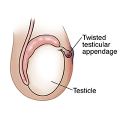 Side view of testicle showing twisted testicular appendage.