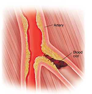 Cross section of peripheral artery with plaque buildup and blood clot.