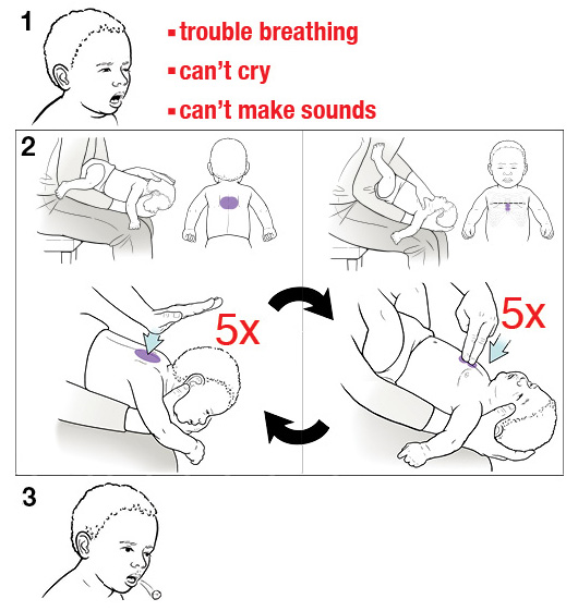 3 steps for doing the Heimlich maneuver on a baby