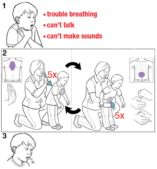 Step-by-step: Heimlich Maneuver For A Child