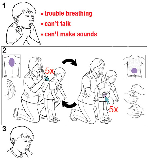 3 steps for doing the Heimlich maneuver on a choking child