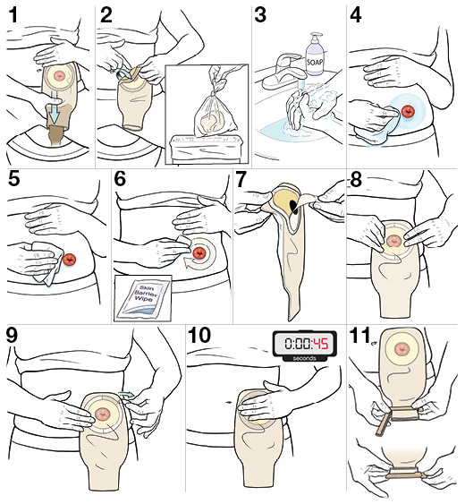 StepbyStep Stoma Care Changing the Pouch