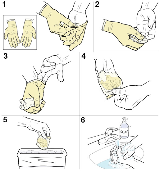 6 steps for removing sterile gloves