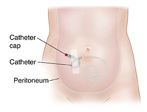 Front view of abdomen showing peritoneal dialysis catheter in place.