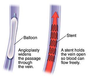 Cross section of vein with balloon catheter. Cross section of vein with stent showing blood flow through stent.