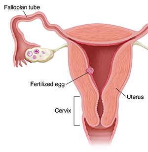 Image showing the fertilized egg traveling down the fallopian tube into the uterus.The cervix is also shown.