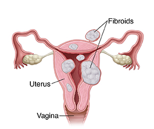 Front view cross section of uterus showing fibroids.