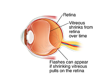 Side view cross section of eye showing vitreous shrinking and pulling on retina.