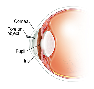 Side view cross section of front of eye showing iris, pupil, and foreign object stuck in cornea.