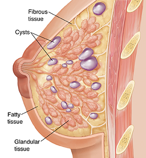 Side view cross section of breast showing glandular, fibrous, and fatty tissue.  Multiple cysts throughout breast.