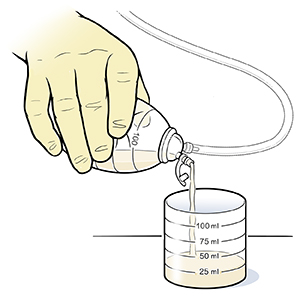 Caring for a Closed Suction Drainage Tube