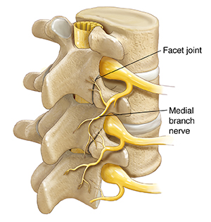 Three-quarter view of three vertebrae and disks showing spinal cord, spinal nerves, and medial branch nerves.