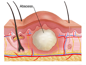 Cross section through skin layers showing abscess.