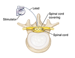 Top view of vertebra and spinal cord showing spinal cord stimulator.